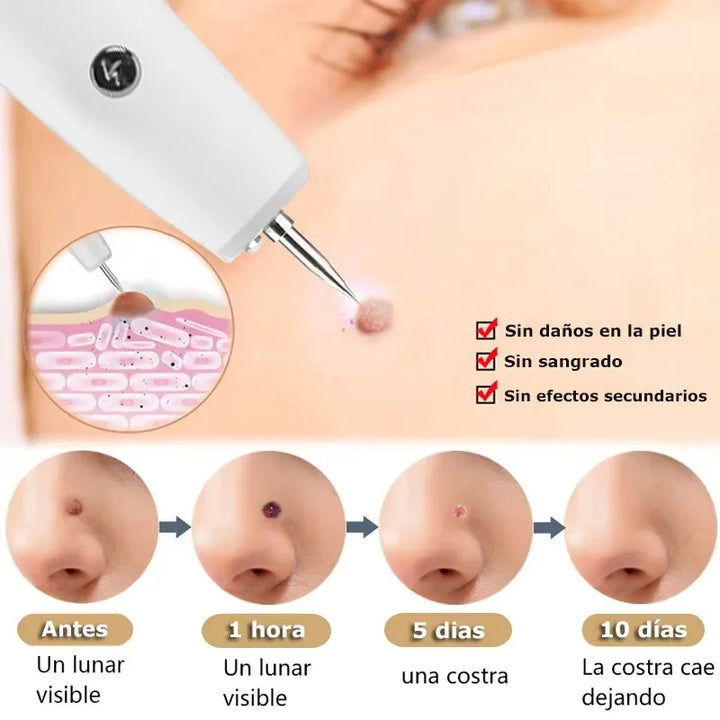 SkinPro Laser – Removedor de Manchas e Verrugas.