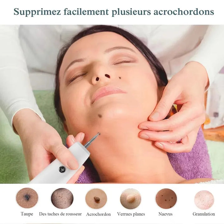 SkinPro Laser – Removedor de Manchas e Verrugas.